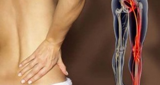 Nhận biết triệu chứng đau thần kinh tọa